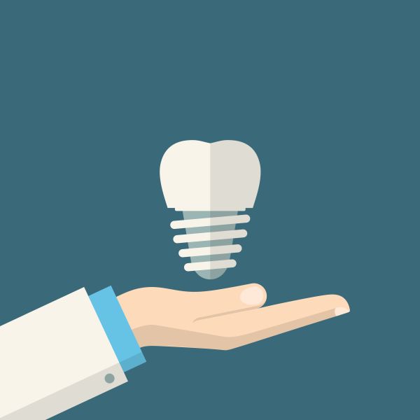 Advantages Of Getting Dental Implants