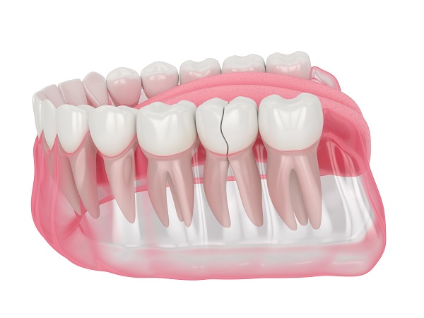 Replacement of dental veneers for receding gums - Bauer Smiles