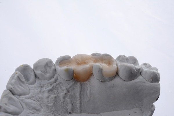 Will A Dental Onlay Fall Off?