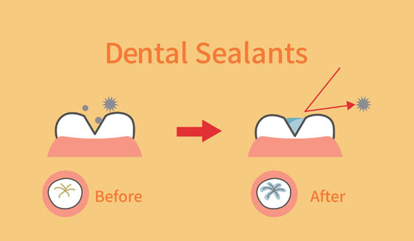 Can Dental Sealants Be Used For Adults?