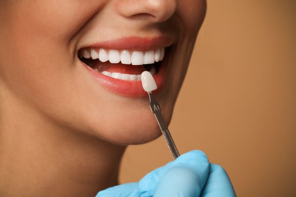 Tips To Keep Your Dental Veneers Looking Brand New