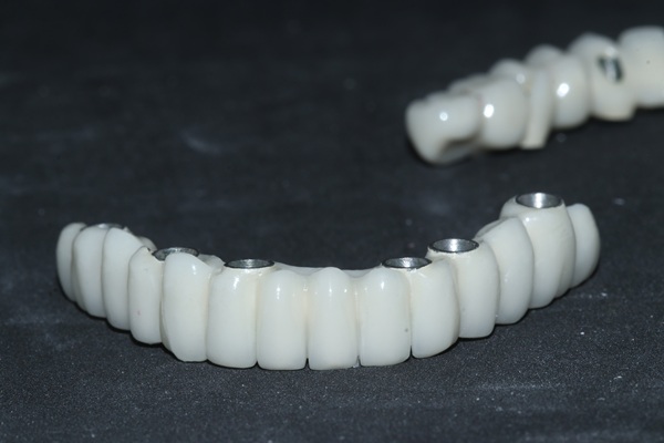 Implant Supported Dentures Can Solve The Problem Of Missing Teeth