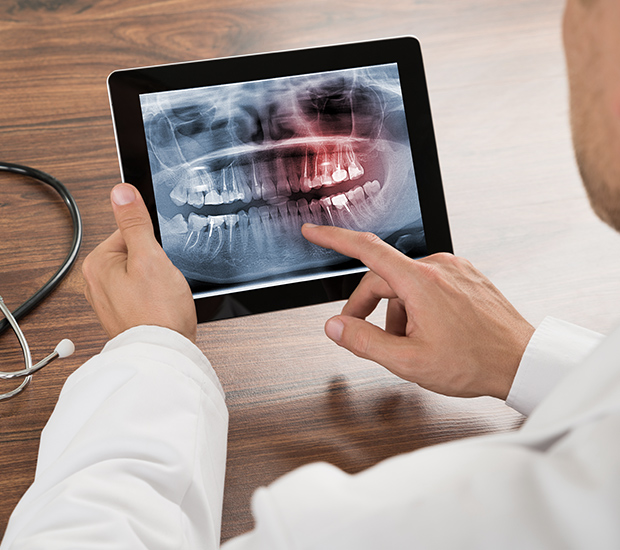 Santa Rosa Types of Dental Root Fractures