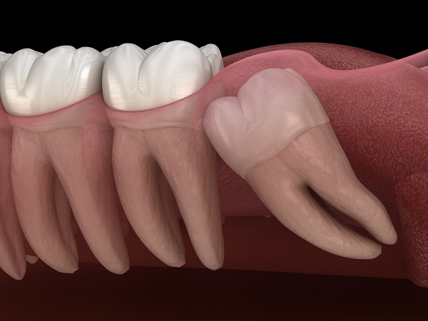 wisdom tooth extraction Santa Rosa, CA